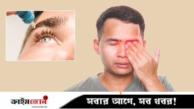 চোখ আগুনে ক্ষতিগ্রস্ত হলে কী করা জরুরি