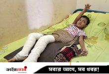 বাসে রেডিয়েটর বিস্ফোরণে দগ্ধ শিশুটি যন্ত্রণায় কাতরাচ্ছে