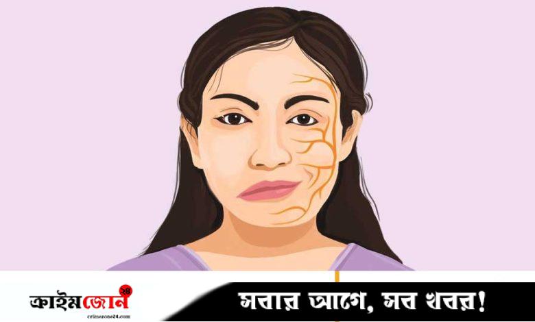 মুখ বেঁকে যাওয়া রোগের চিকিৎসা