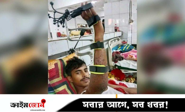 শরীরে ৪০০ স্প্রিন্টার, যন্ত্রণায় ঘুমাতে পারেন না জুলাই যোদ্ধা হাসান